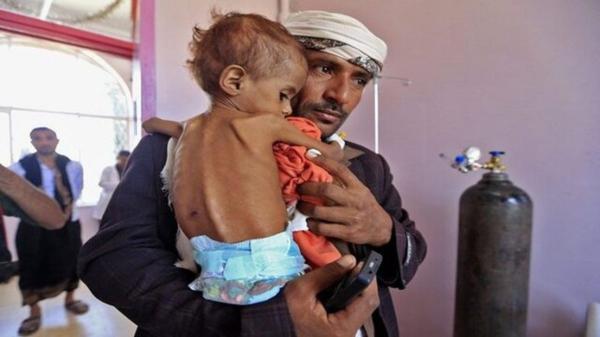 هشدار یونیسف نسبت به بحران گرسنگی در یمن